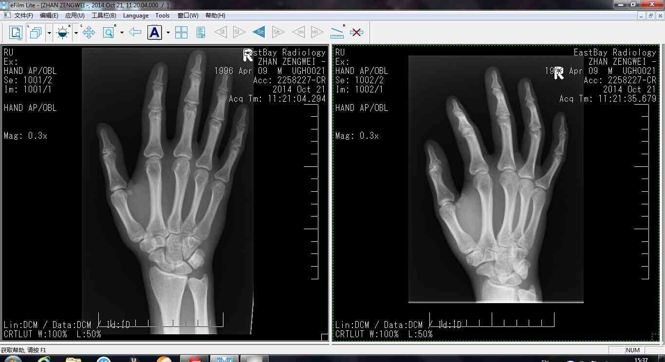 正常的手腕骨骼x光图图片
