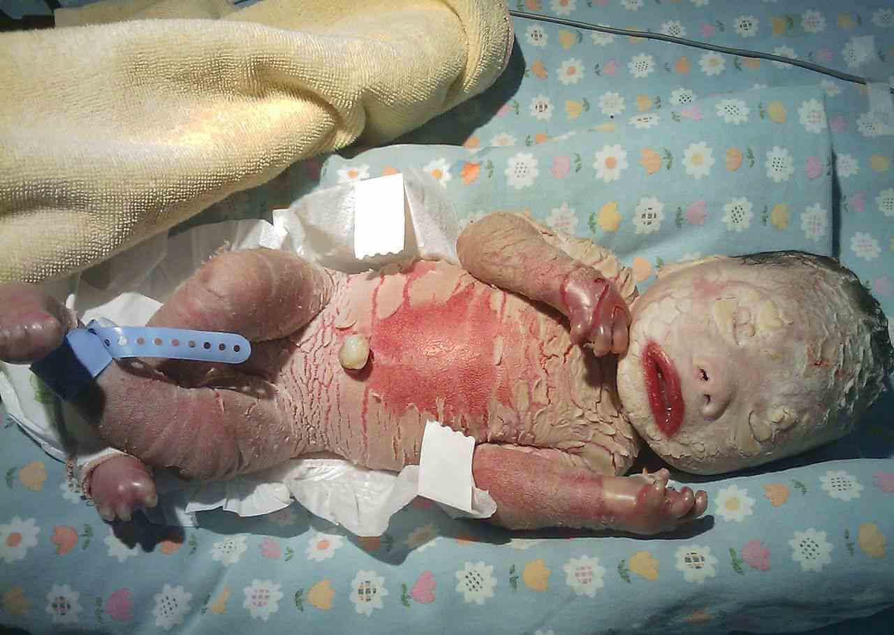 火棉胶婴儿会在出生后24小时脱皮