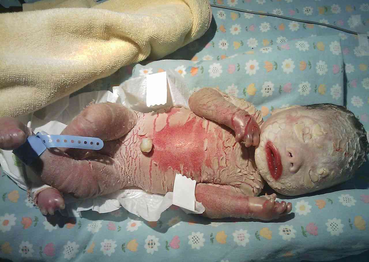 火棉胶婴儿是罕见的鱼鳞病