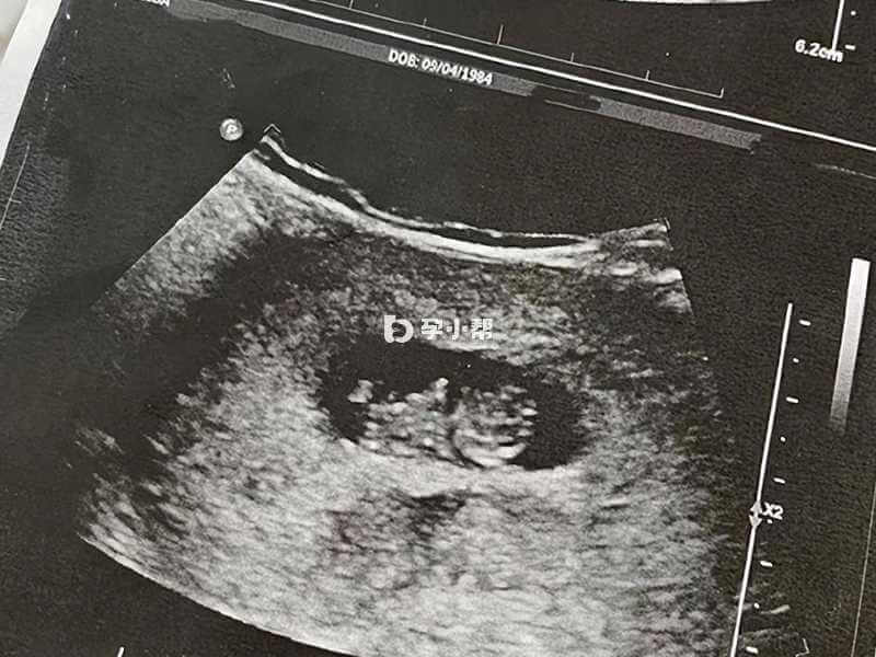 同卵双胞胎在孕13周左右才能查出