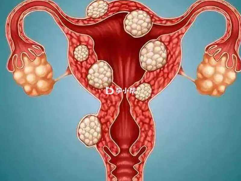 子宫肌瘤可能导致月经不调