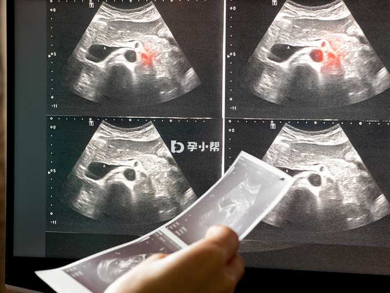输卵管造影可以诊断输卵管通畅性