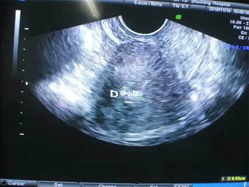 阴道超声监测卵泡