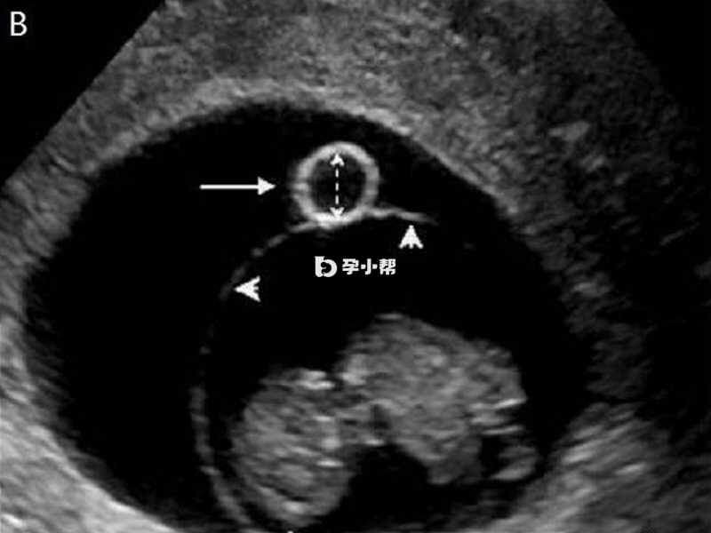 孕囊直径在5-6mm时可通过超声发现卵黄囊