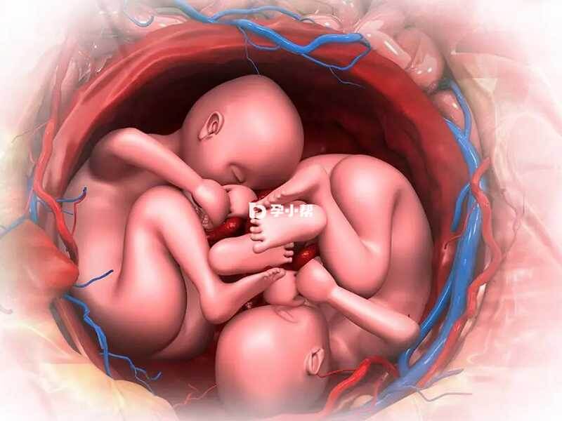 单卵双胎