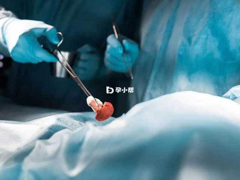 剖宫产手术