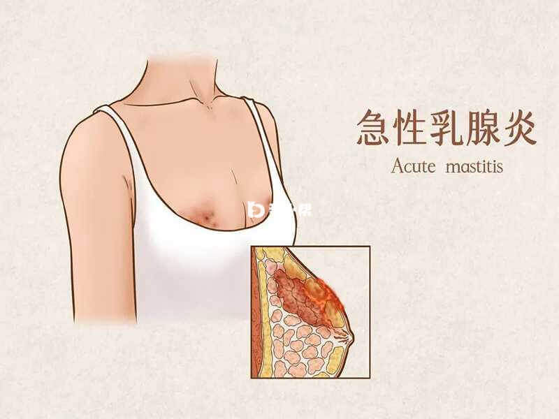 急性乳腺炎：哺乳期的喂养之痛(图2)