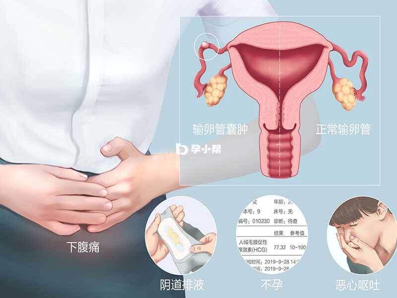 输卵管囊肿-原因及治疗方法-对怀孕的影响(图2)