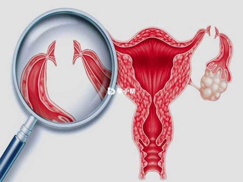 卵巢炎：被忽视的一种女性盆腔炎(图1)