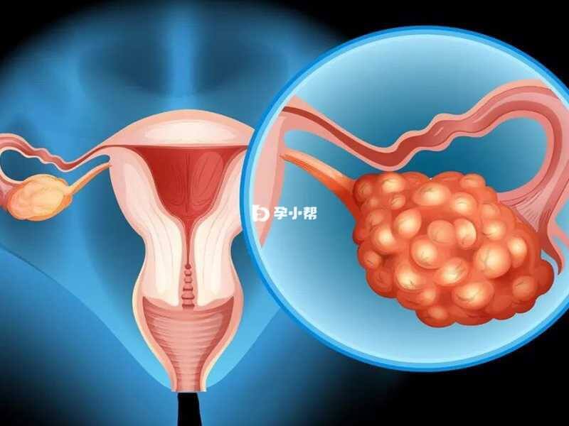卵巢过度刺激综合征(OHSS)：辅助生殖技术常见并发症