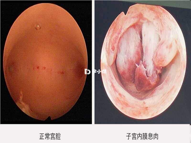 子宫内膜间质肉瘤-恶性肿瘤治疗方法-术后存活率(图2)