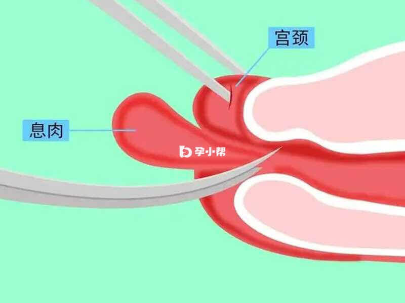 子宫内膜息肉：宫腔镜下的不速之客