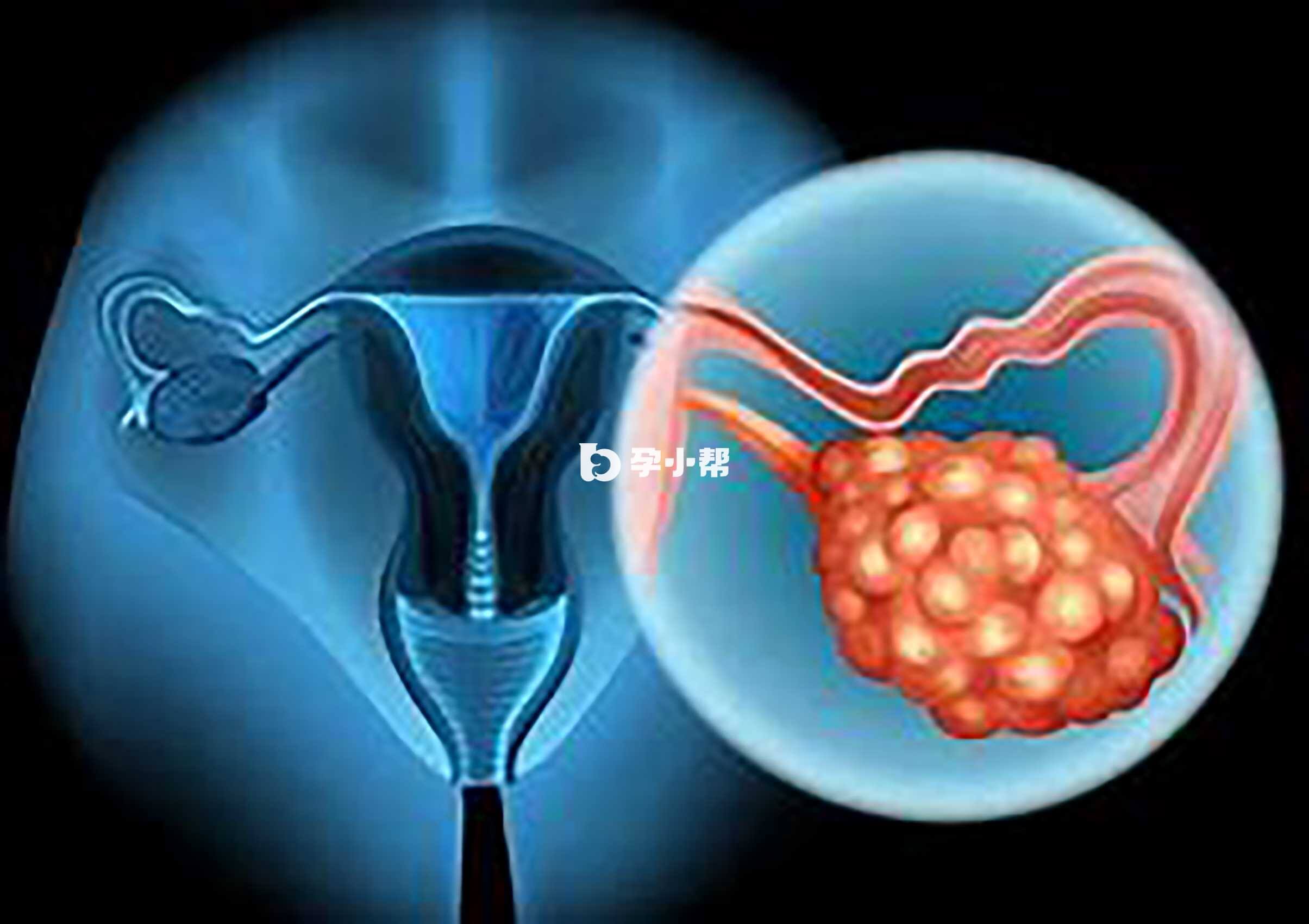 卵巢无性细胞瘤