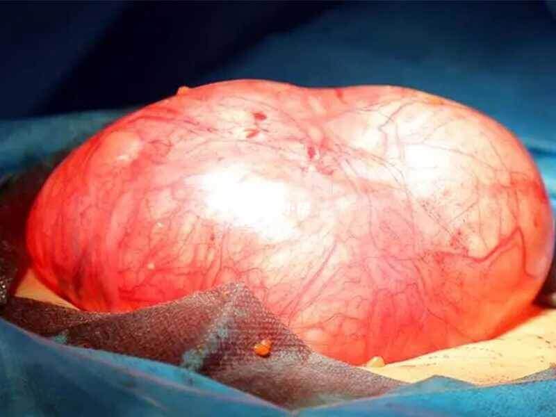 卵巢颗粒细胞瘤是罕见的卵巢癌
