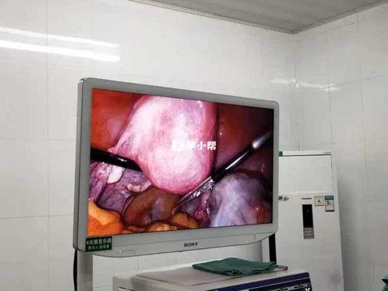 腹腔镜下的妊娠合并子宫肌瘤