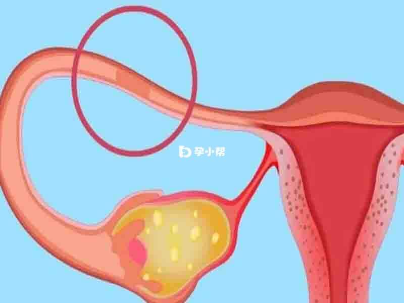 造成慢性输卵管卵巢炎的原因有很多