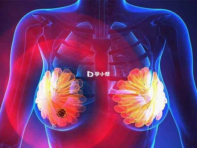 乳腺癌肉瘤发病于乳房