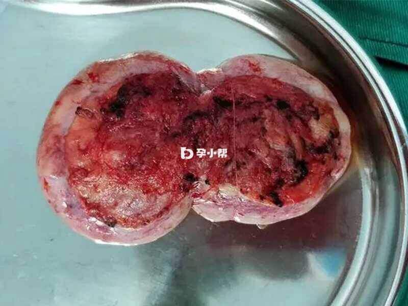 手术切除的外阴脂肪肉瘤