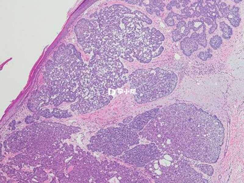 外阴基底细胞癌常伴有其他肿瘤