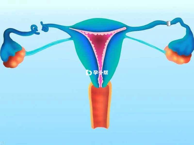 阴道癌是指原发于阴道的恶性肿瘤