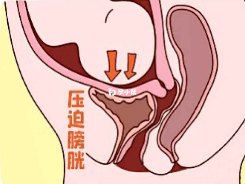 产后尿潴留是一种比较常见的症状