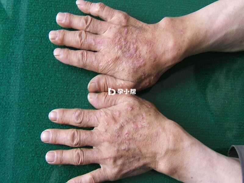 扁平苔藓是特发性炎症性皮肤病