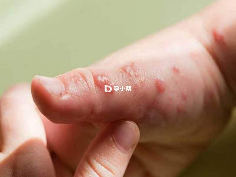 出皮疹期间一般会有疼痛