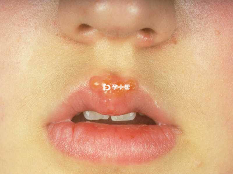 单纯疱疹发生在唇部称为唇疱疹