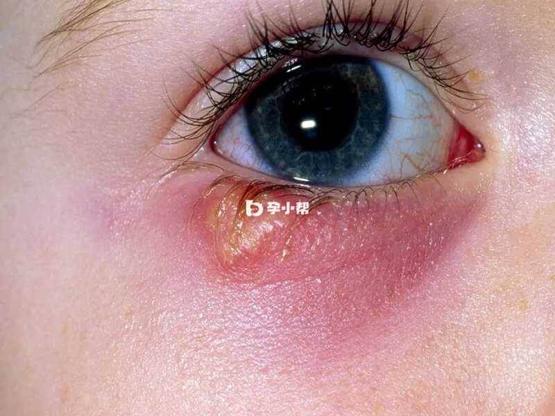 颜面疱疹可以发生在眼皮等部位