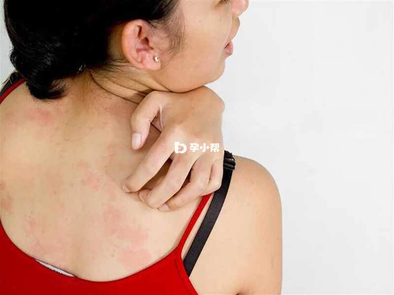过敏性皮炎会使患者皮肤出现湿疹