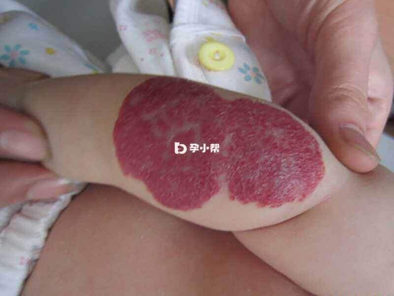 毛细血管瘤是婴儿期常见疾病
