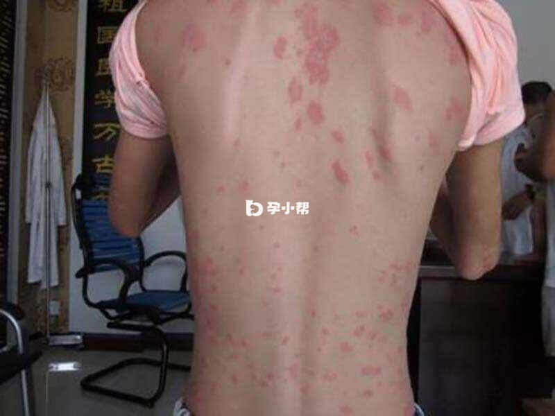 玫瑰糠疹是一种常见的皮肤病