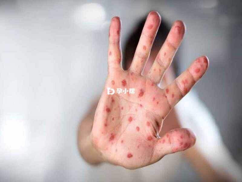 麻疹患者是唯一的传染源