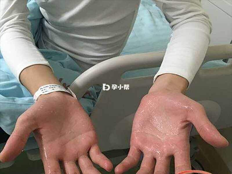 手汗症常见于少年及青年人