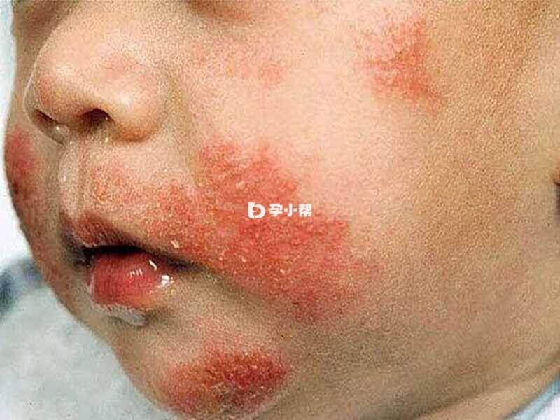 湿疹是一种过敏性炎症性皮肤病