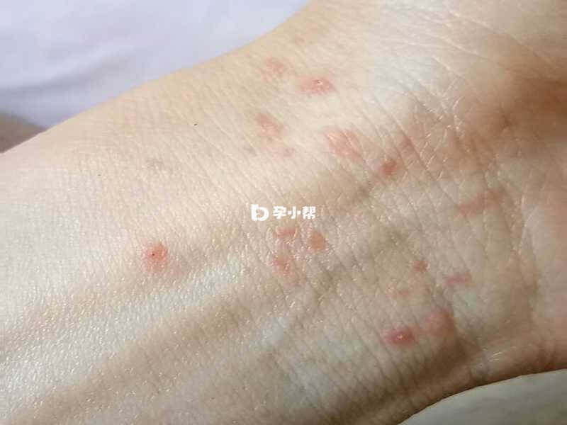 皮疹是一种皮肤病变
