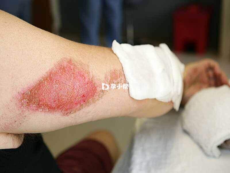 结缔组织病也会导致出现皮疹