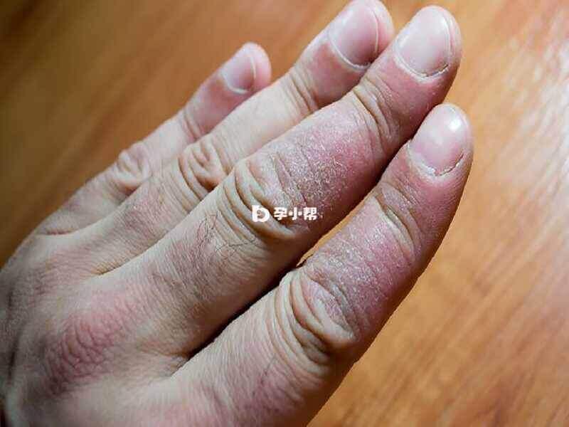 手足癣是最常见的浅部真菌病