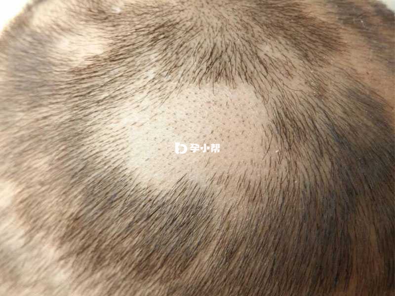 系统性红斑狼疮可能表现为斑秃