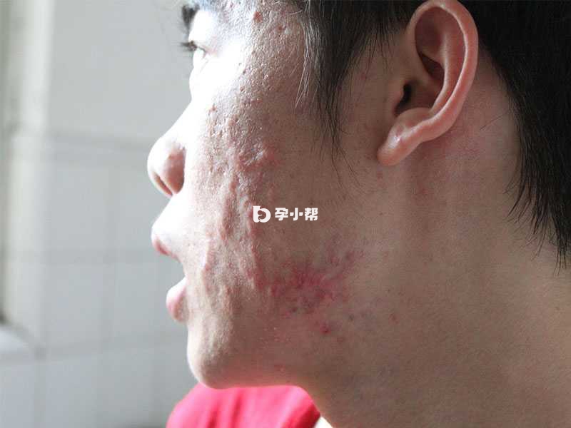 痤疮是皮肤科里面比较常见的疾病