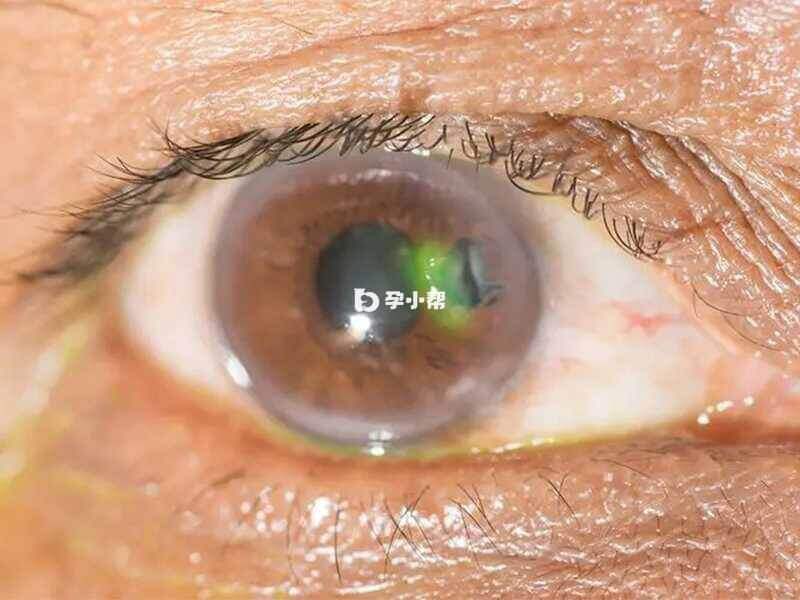 青光眼患者的眼睛
