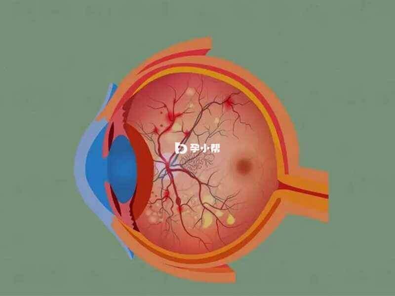 视网膜细胞瘤可能出现斗鸡眼