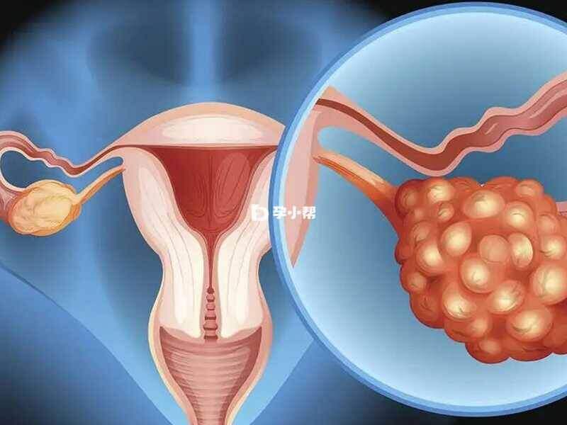 宫腔与子宫内膜分离