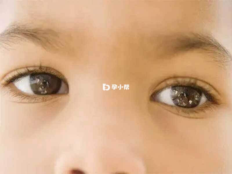 视网膜色素变性通常出现在儿童时期