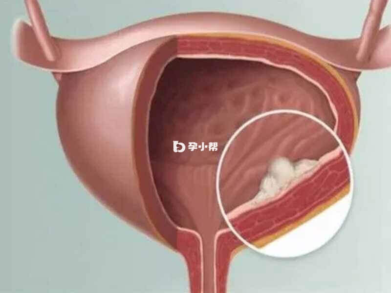 膀胱癌患者有无痛性肉眼血尿等症状