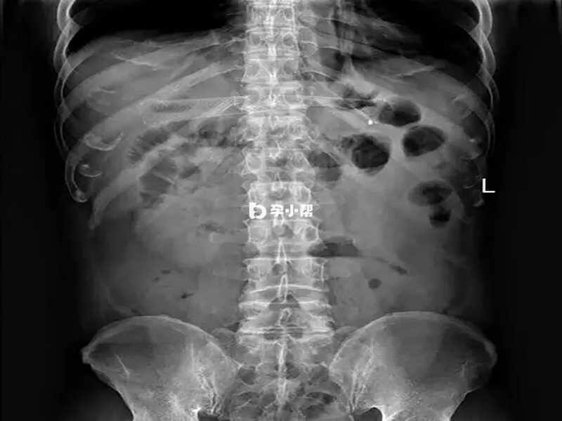 x光照射下的腹痛透视图