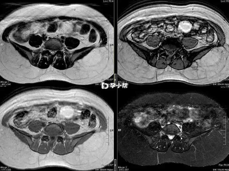畸胎瘤患者的x光片