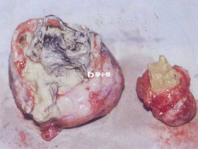 畸胎瘤病理细胞