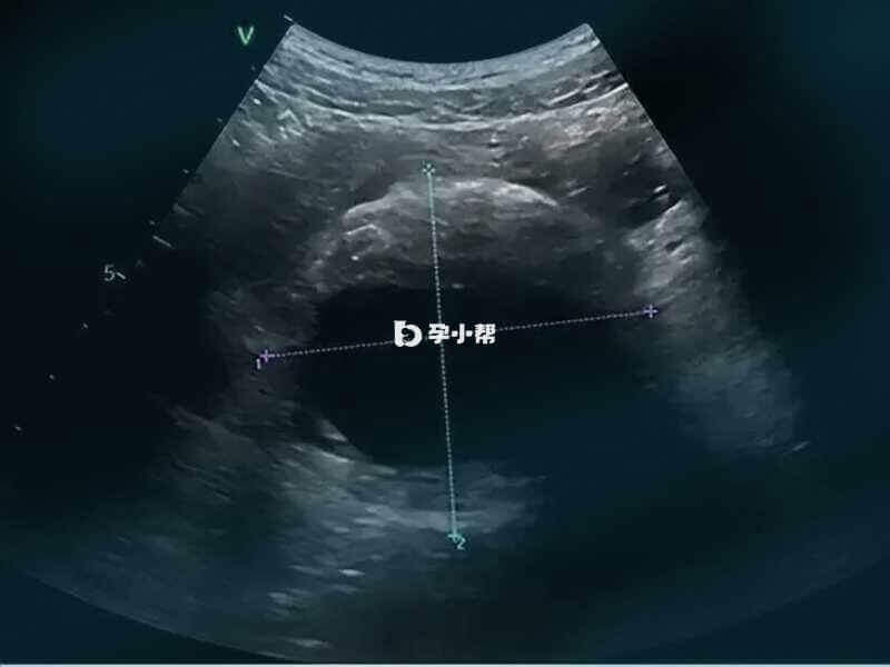 卵巢b超检查