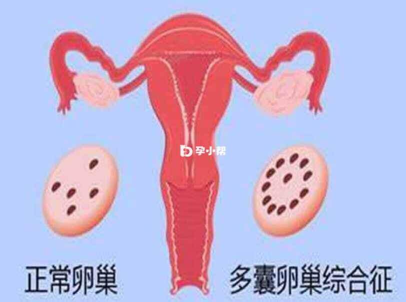 偏多的情况需考虑有多囊卵巢的可能